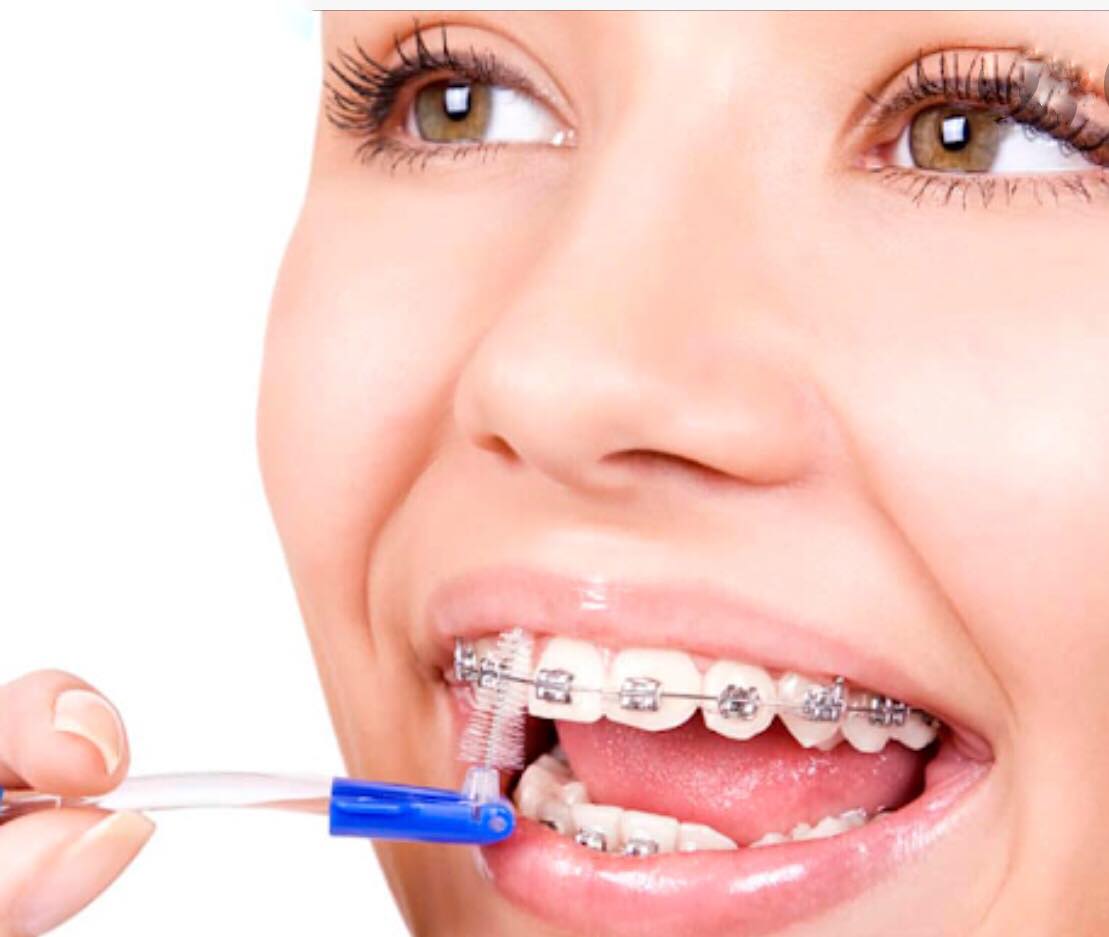 Догляд за зубами з брекетами